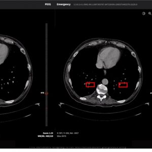 تشخیص 2 دقیقه ای بیماری کرونا توسط سامانه هوشمند ایرانی