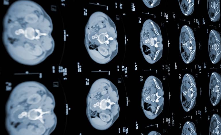 مدل جدید هوش مصنوعی MIT قادر به تشخیص زودهنگام سرطان پانکراس است